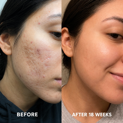 Acne Scar Remodeling Stick™